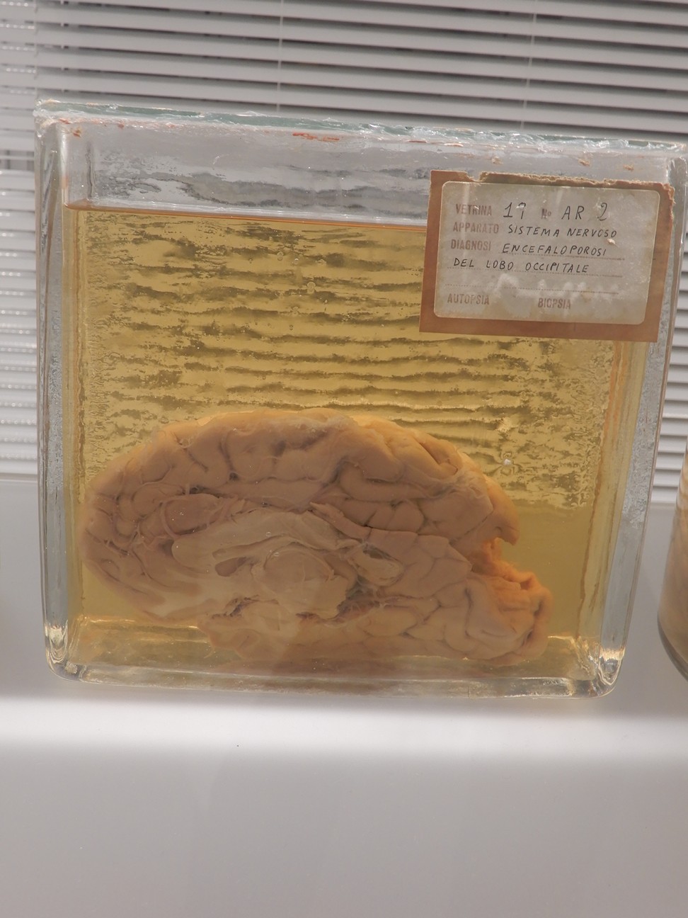 singolo reperto antropologico, preparato anatomico (morfologia alterata per patologia) (XIX-XX)