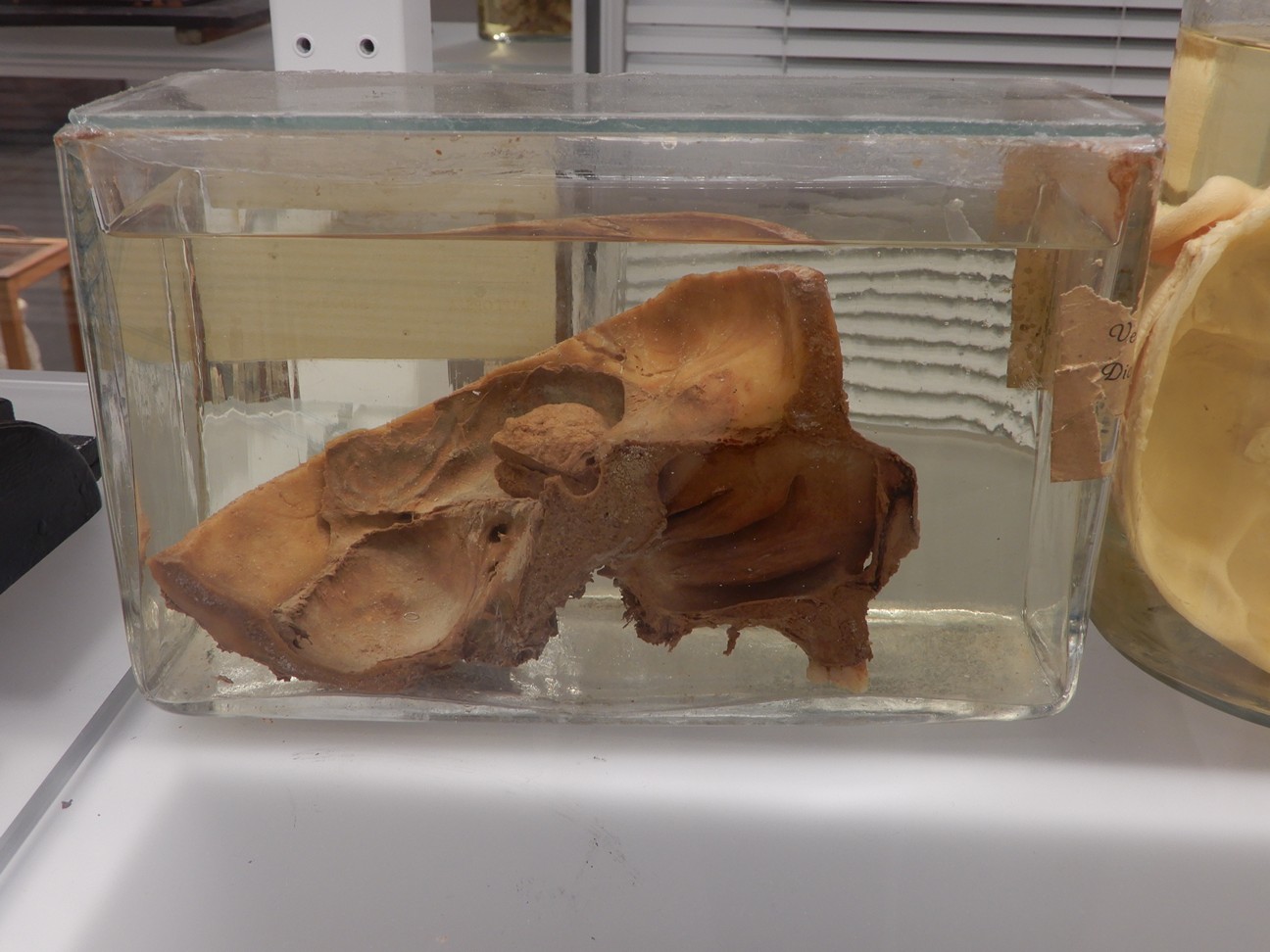 singolo reperto antropologico, preparato anatomico (morfologia alterata per patologia) (XIX-XX)