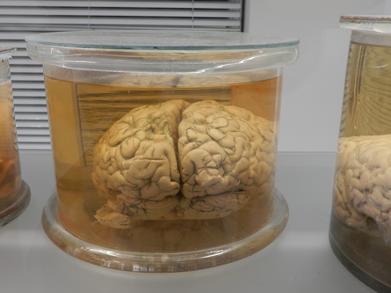 singolo reperto antropologico, preparato anatomico (morfologia alterata per patologia) (XIX-XX)