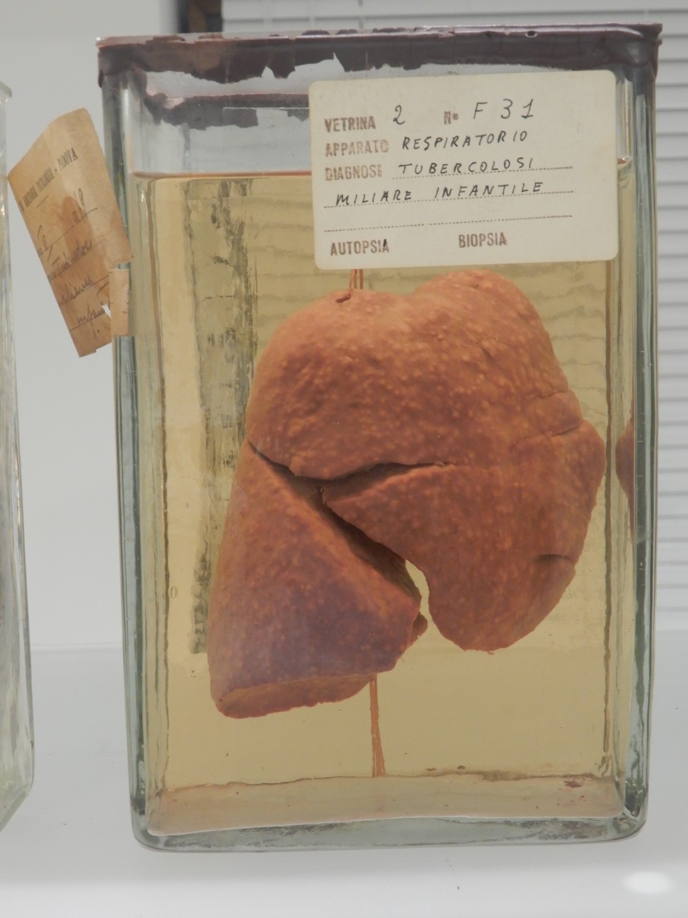 singolo reperto antropologico, preparato anatomico (morfologia alterata per patologia) (XIX-XX)