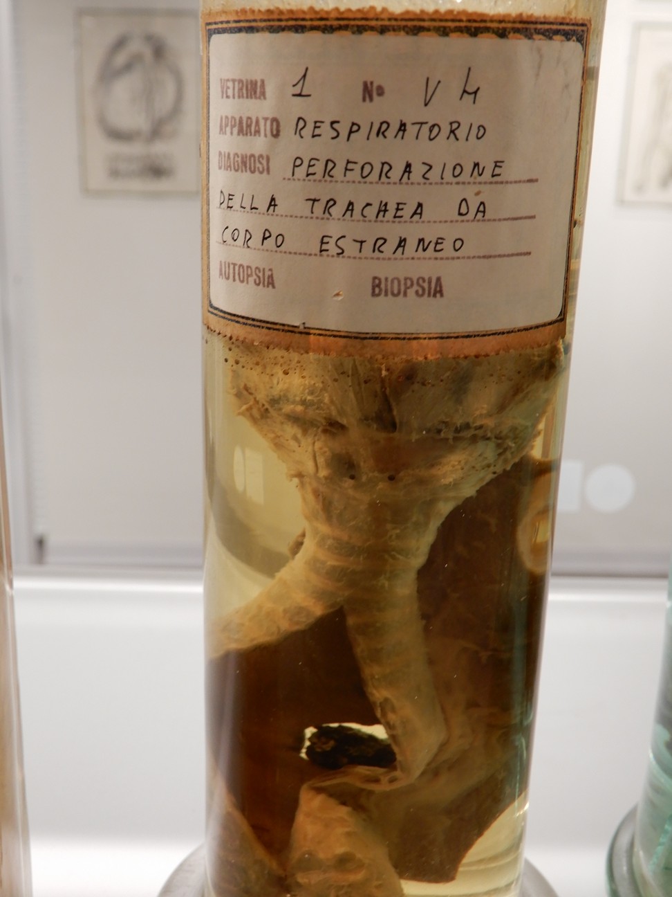 singolo reperto antropologico, preparato anatomico (morfologia alterata per patologia) (XIX-XX)