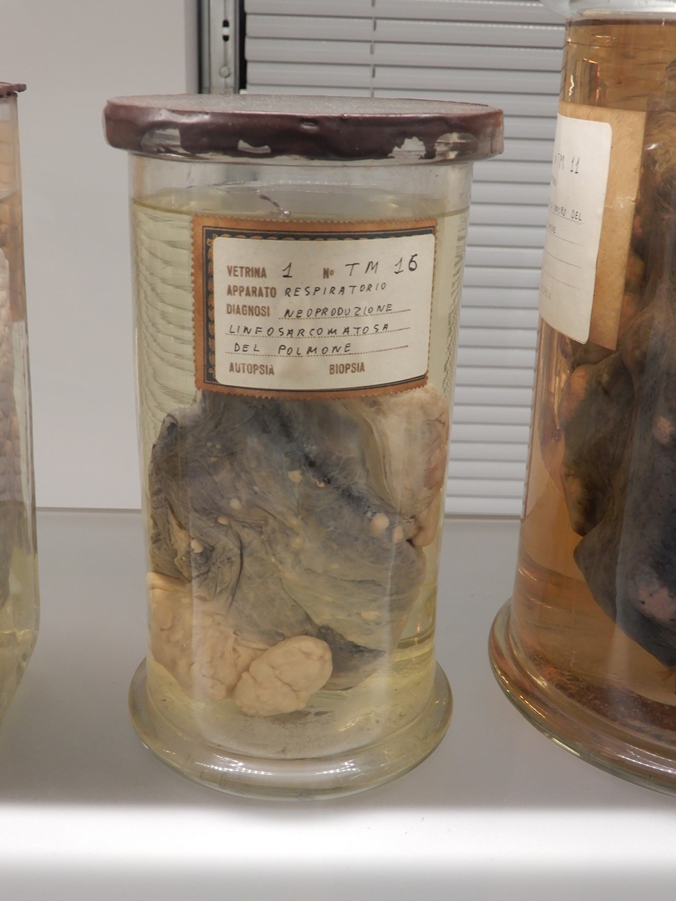 singolo reperto antropologico, preparato anatomico (morfologia alterata per patologia) (XIX-XX)