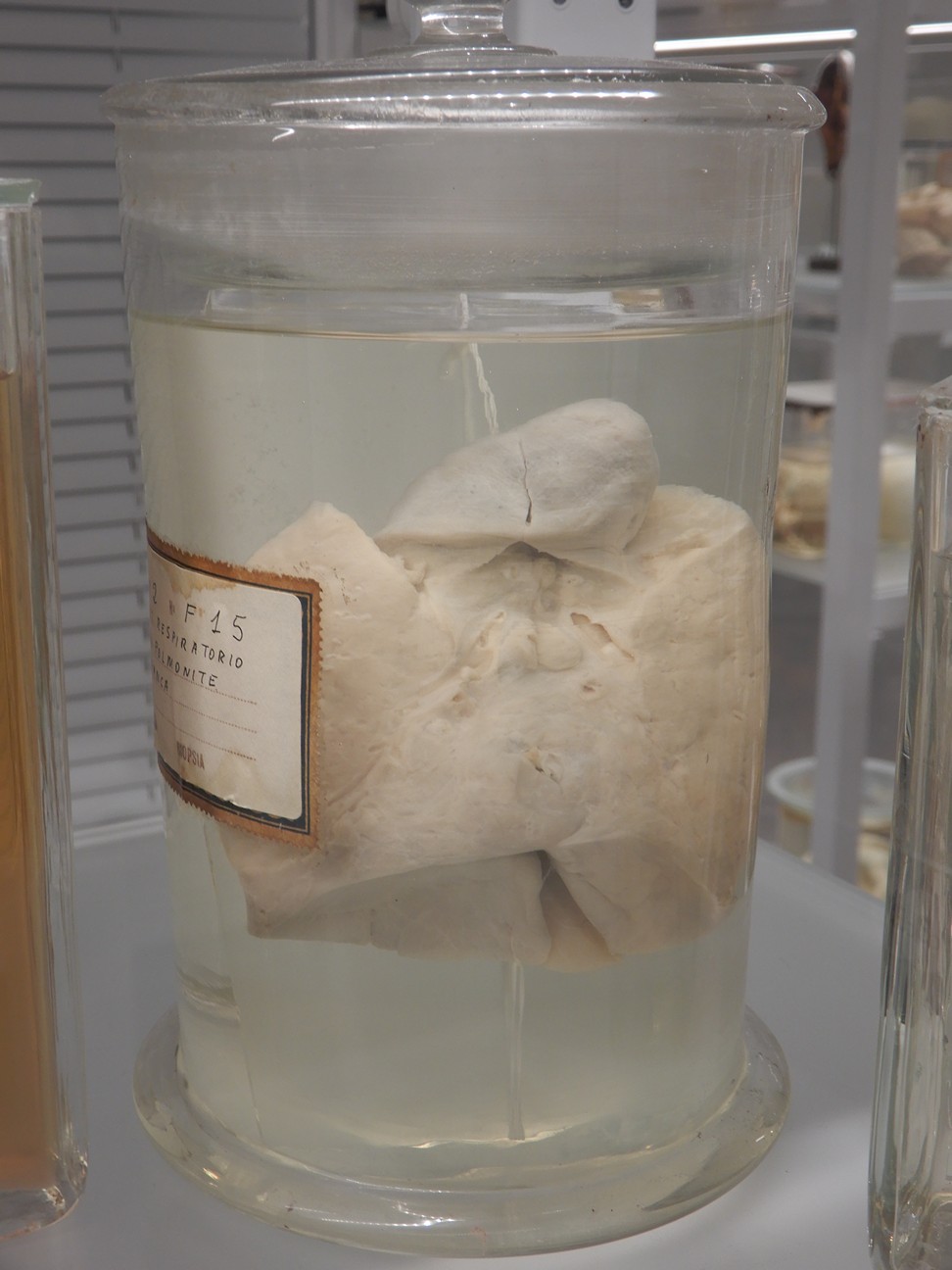 singolo reperto antropologico, preparato anatomico (morfologia alterata per patologia) (XIX-XX)