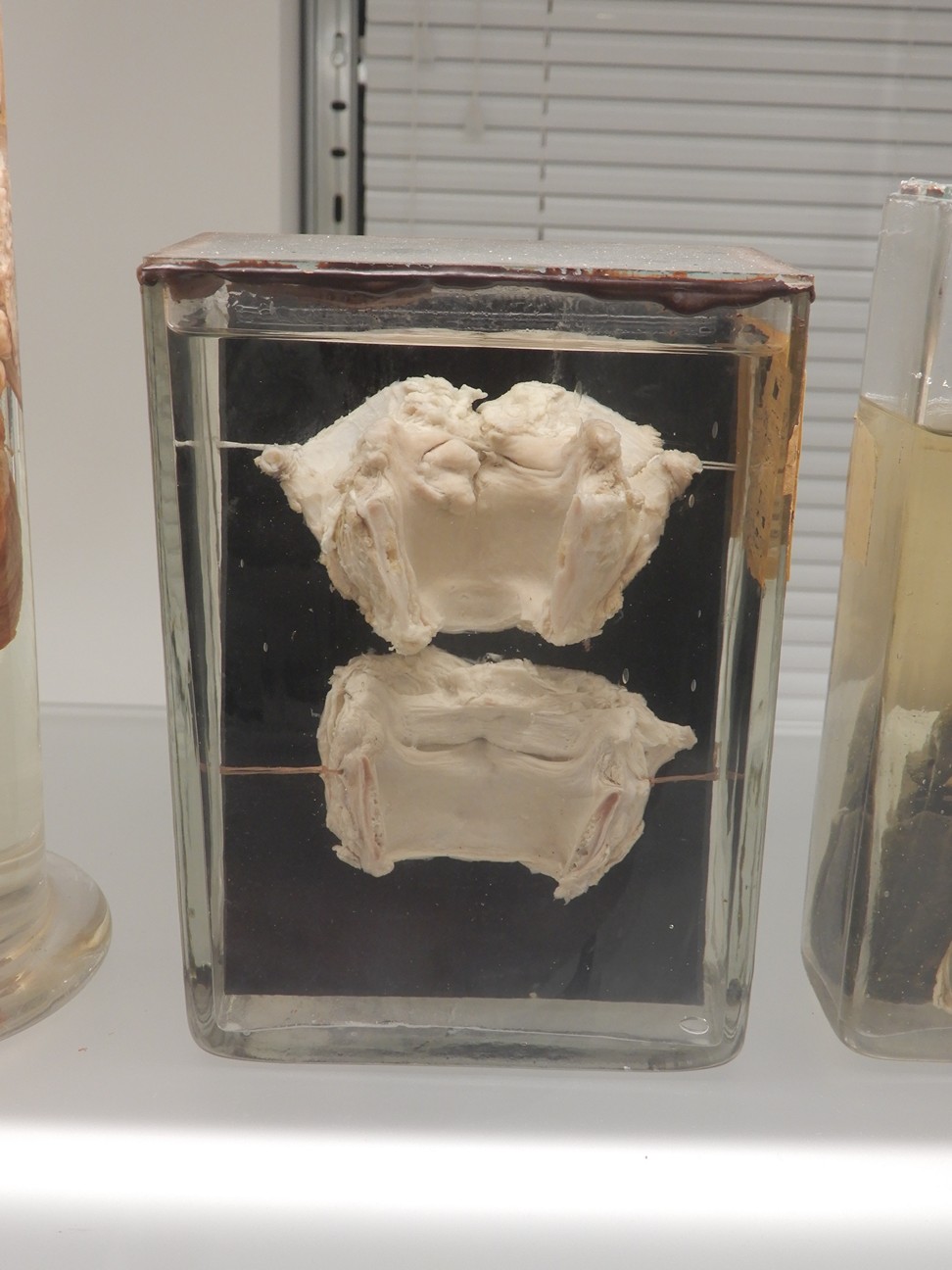 singolo reperto antropologico, preparato anatomico (morfologia alterata per patologia) (XIX-XX)