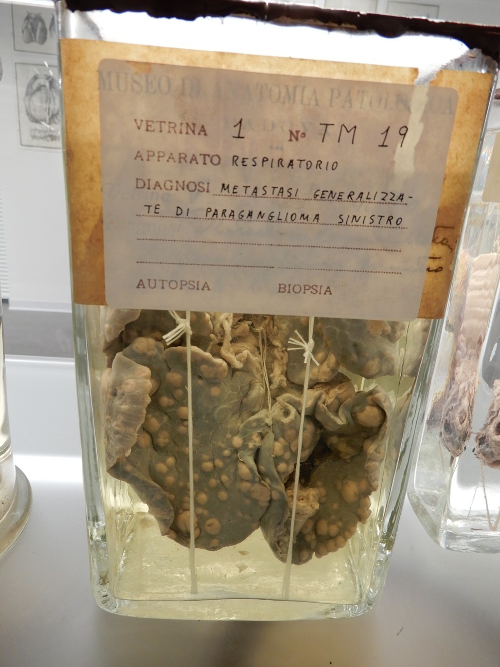 singolo reperto antropologico, preparato anatomico (morfologia alterata per patologia) (XIX-XX)