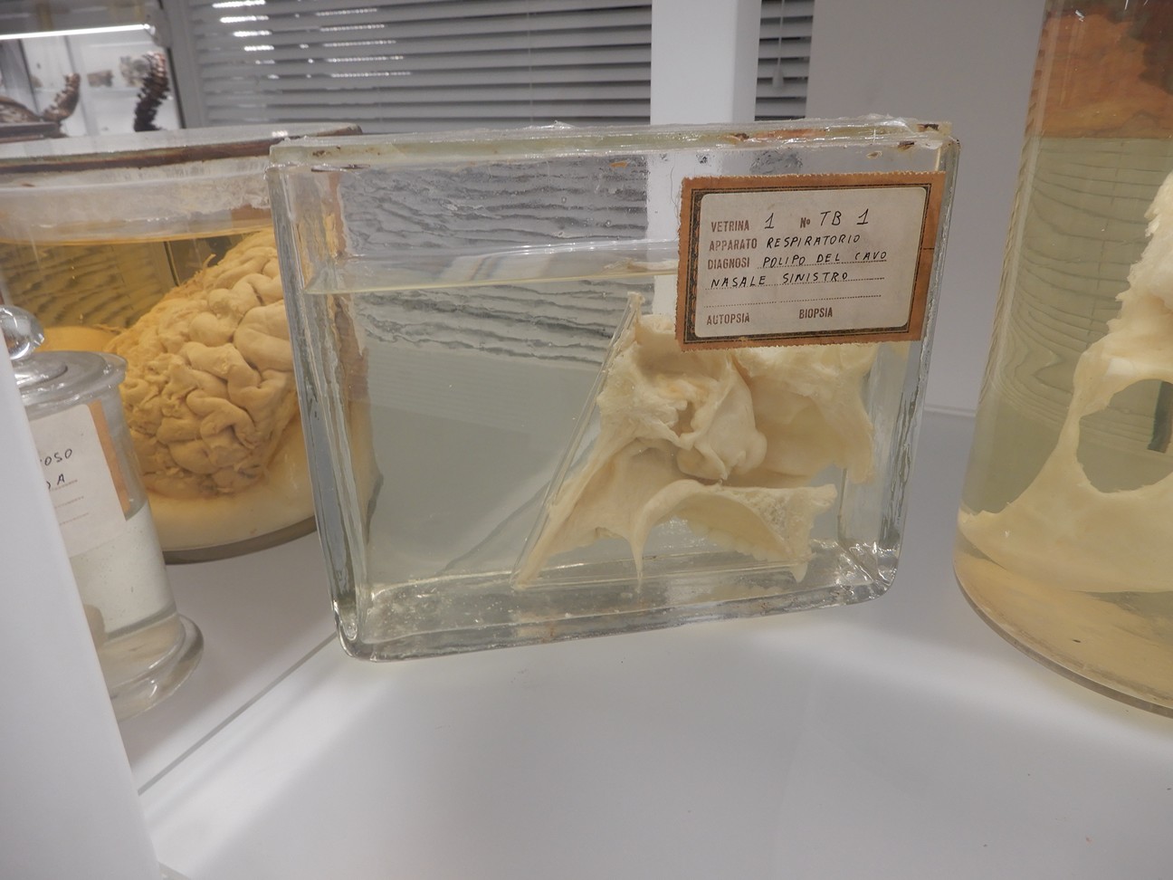 singolo reperto antropologico, preparato anatomico (morfologia alterata per patologia) (XIX-XX)