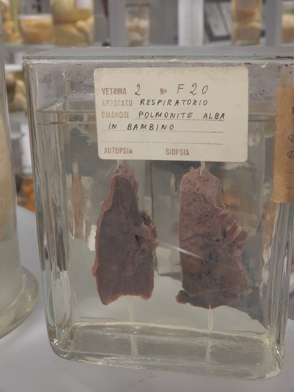 singolo reperto antropologico, preparato anatomico (morfologia alterata per patologia) (XIX-XX)