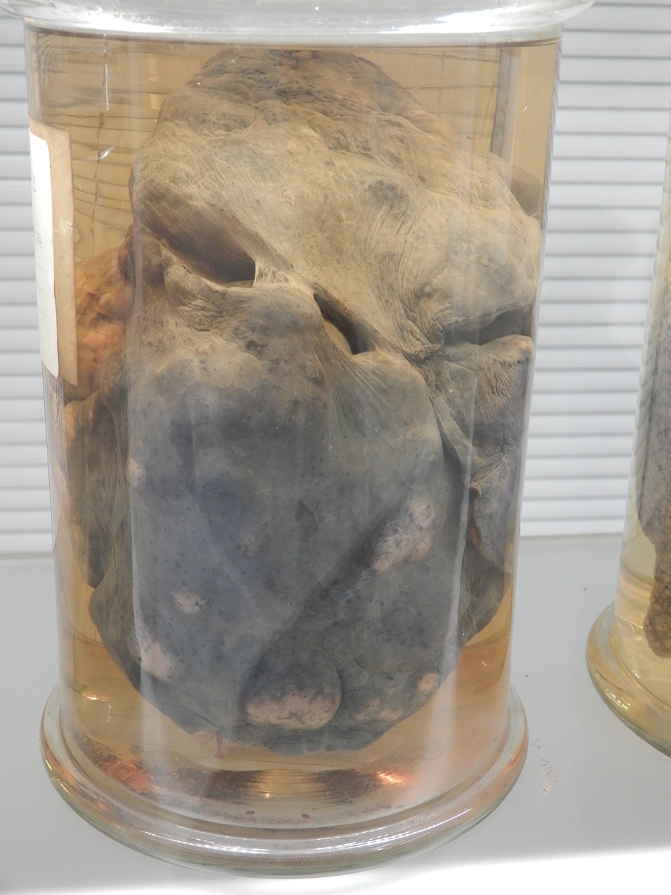 singolo reperto antropologico, preparato anatomico (morfologia alterata per patologia) (XIX-XX)