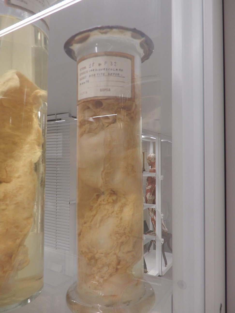 singolo reperto antropologico, preparato anatomico (morfologia alterata per patologia) (XIX-XX)