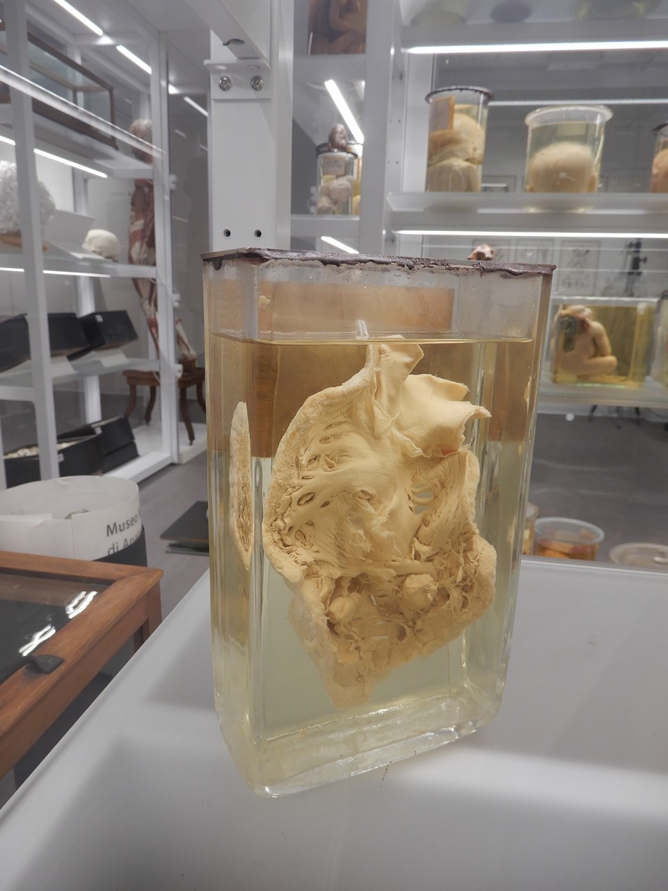 singolo reperto antropologico, preparato anatomico (morfologia alterata per patologia) (XIX-XX)