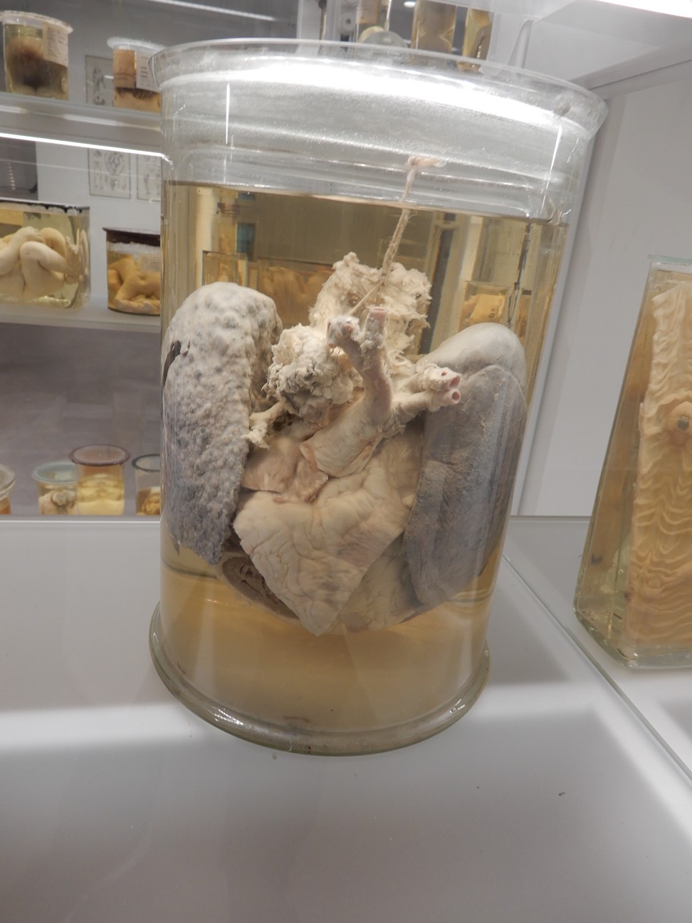 singolo reperto antropologico, preparato anatomico (morfologia alterata per patologia) (XIX-XX)