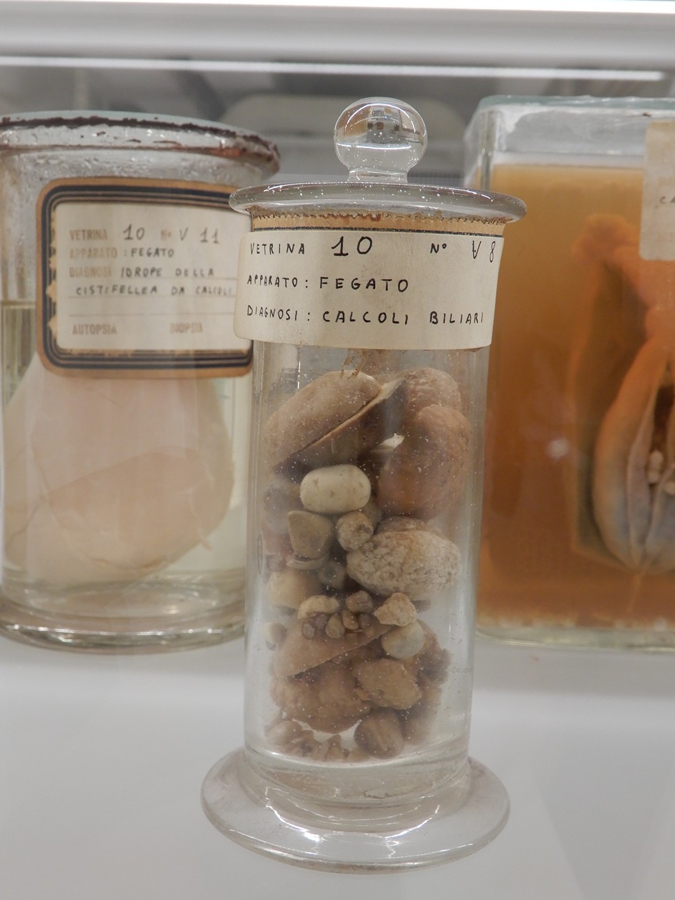 singolo reperto antropologico, preparato anatomico (morfologia alterata per patologia) (XIX-XX)