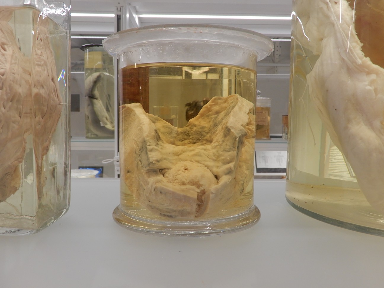 singolo reperto antropologico, preparato anatomico (morfologia alterata per patologia) (XIX-XX)