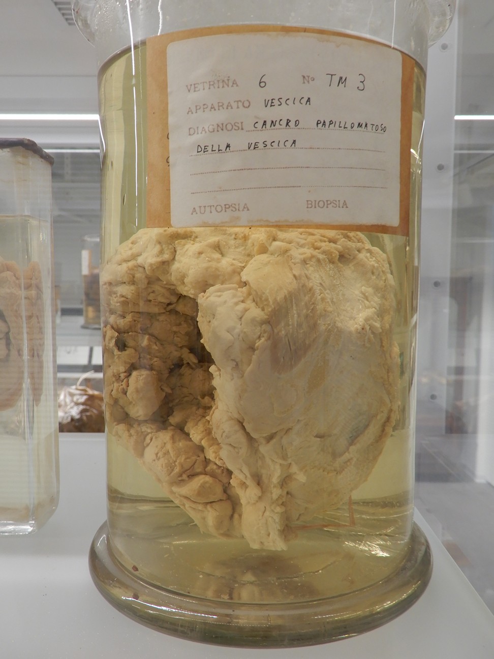 singolo reperto antropologico, preparato anatomico (morfologia alterata per patologia) (XIX-XX)