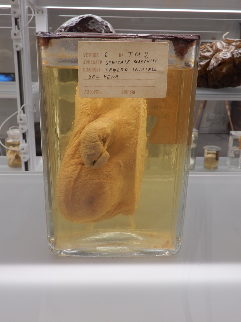 singolo reperto antropologico, preparato anatomico (morfologia alterata per patologia) (XIX-XX)