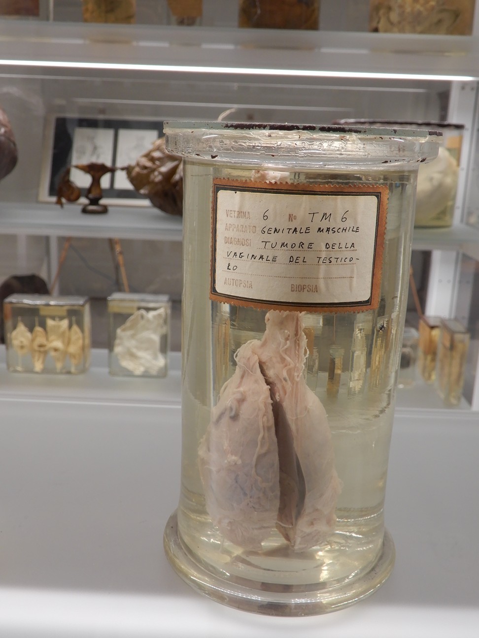 singolo reperto antropologico, preparato anatomico (morfologia alterata per patologia) (XIX-XX)