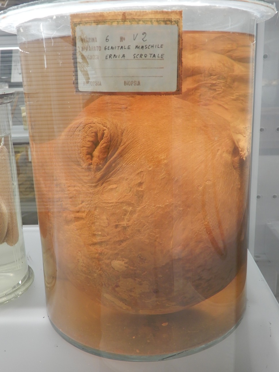 singolo reperto antropologico, preparato anatomico (morfologia alterata per patologia) (XIX-XX)