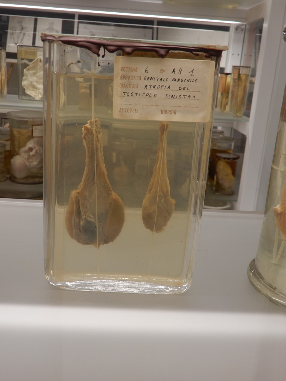 singolo reperto antropologico, preparato anatomico (morfologia alterata per patologia) (XIX-XX)