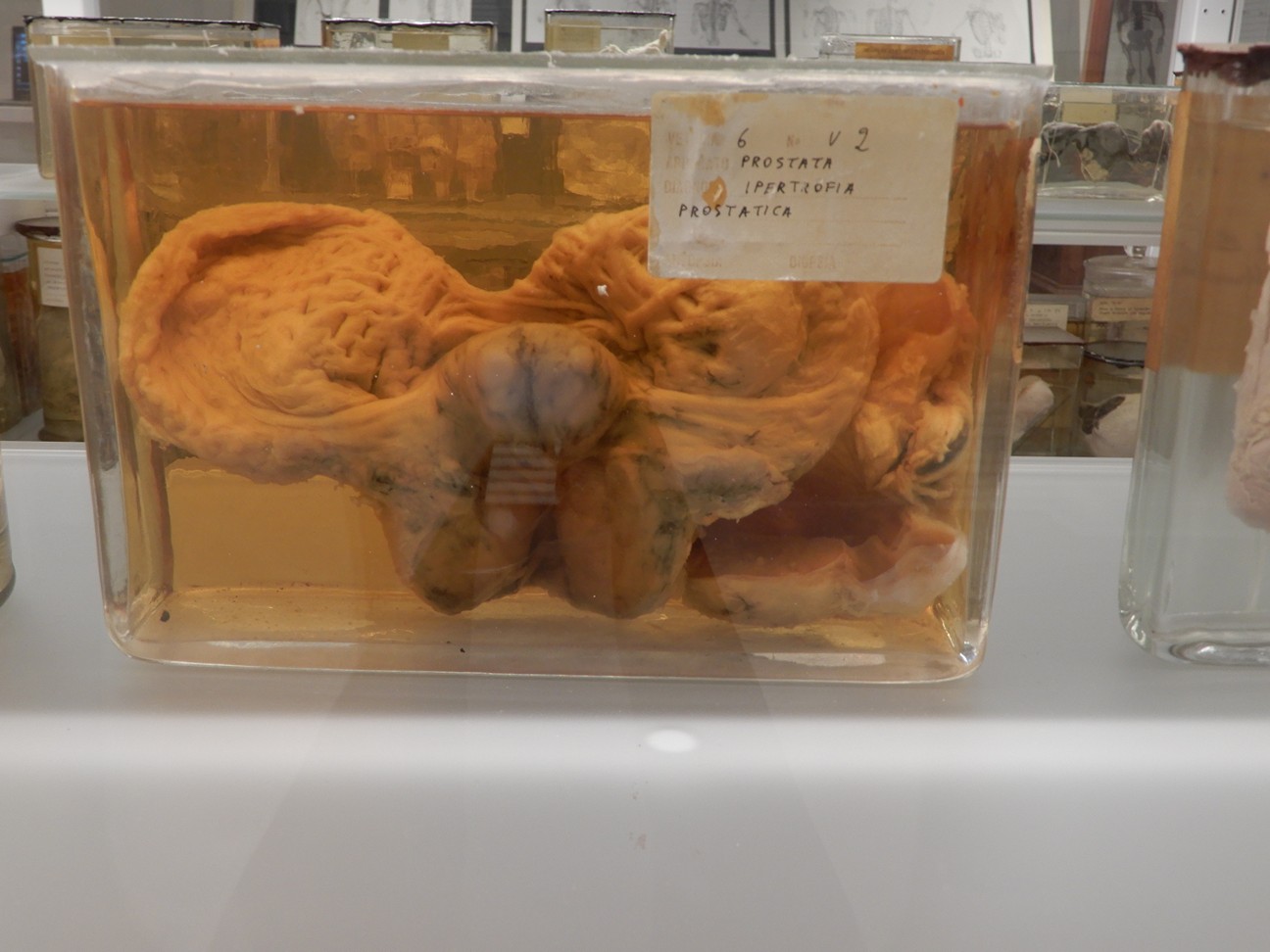 singolo reperto antropologico, preparato anatomico (morfologia alterata per patologia) (XIX-XX)