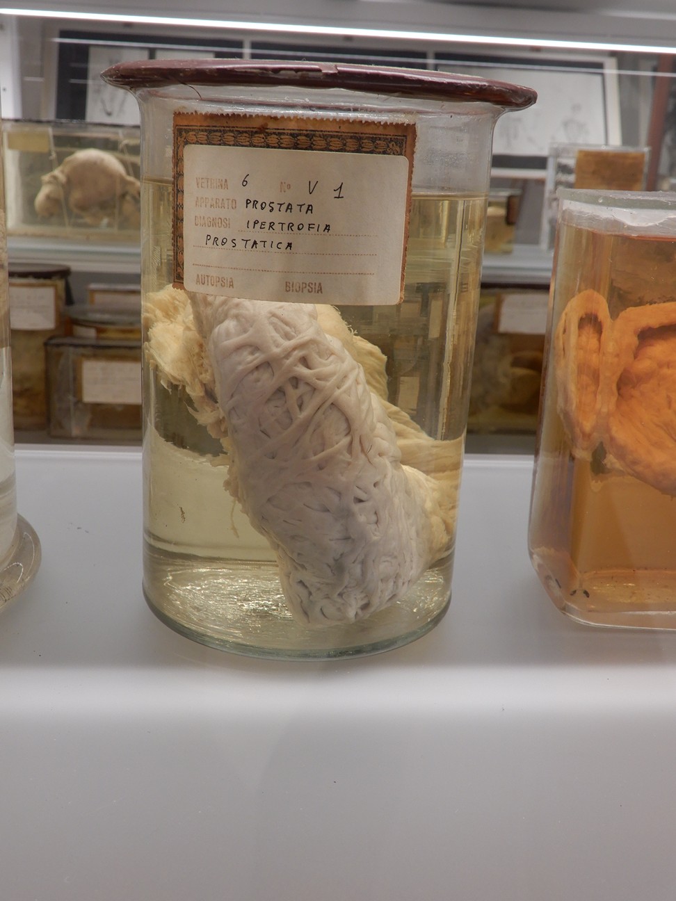 singolo reperto antropologico, preparato anatomico (morfologia alterata per patologia) (XIX-XX)