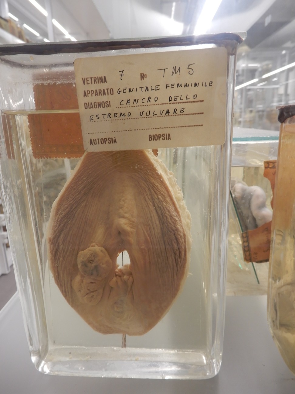 singolo reperto antropologico, preparato anatomico (morfologia alterata per patologia) (XIX-XX)