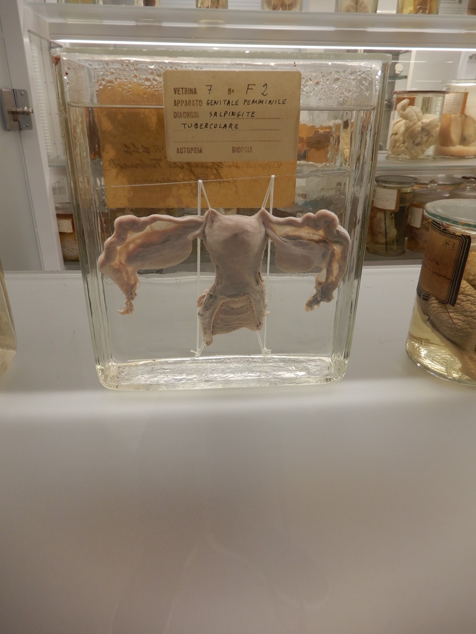 singolo reperto antropologico, preparato anatomico (morfologia alterata per patologia) (XIX-XX)