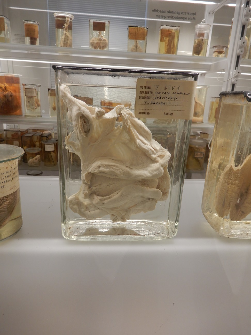 singolo reperto antropologico, preparato anatomico (morfologia alterata per patologia) (XIX-XX)