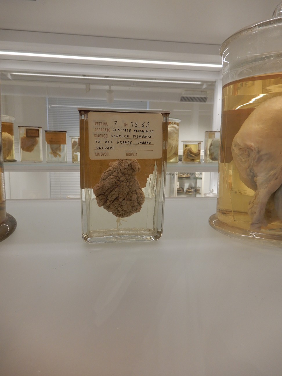 singolo reperto antropologico, preparato anatomico (morfologia alterata per patologia) (XIX-XX)