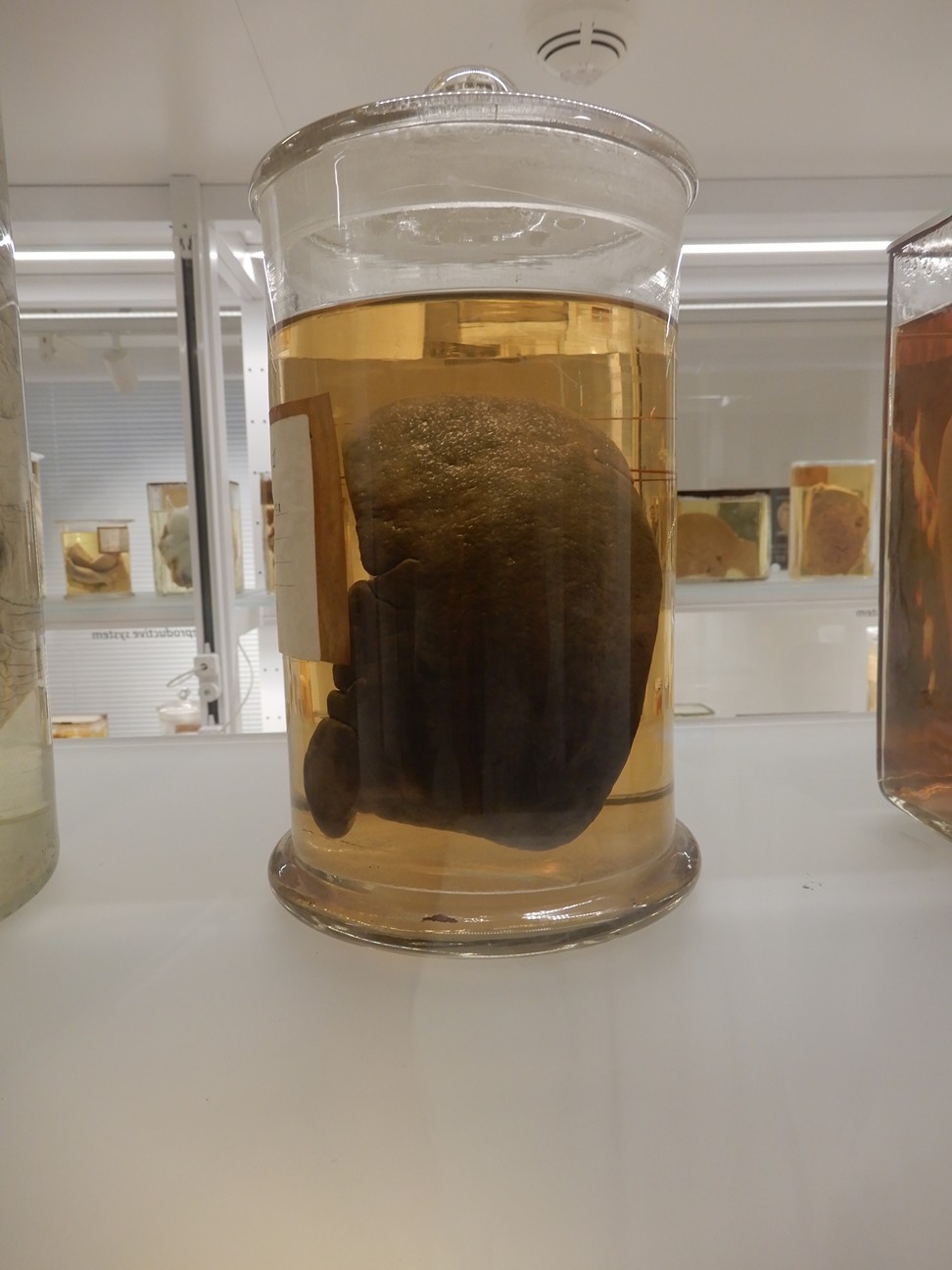 singolo reperto antropologico, preparato anatomico (morfologia alterata per patologia) (XIX-XX)