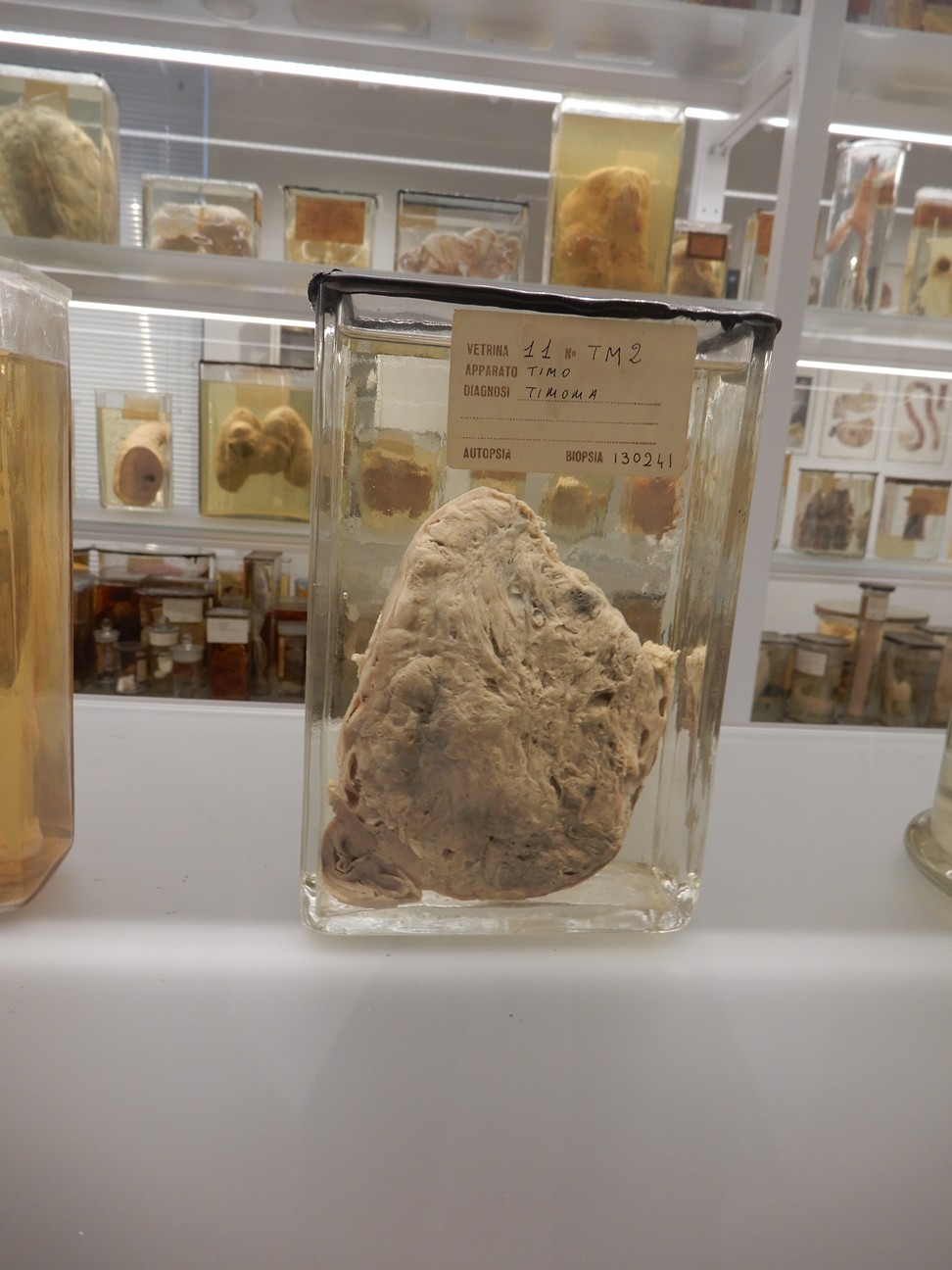 singolo reperto antropologico, preparato anatomico (morfologia alterata per patologia) (XIX-XX)