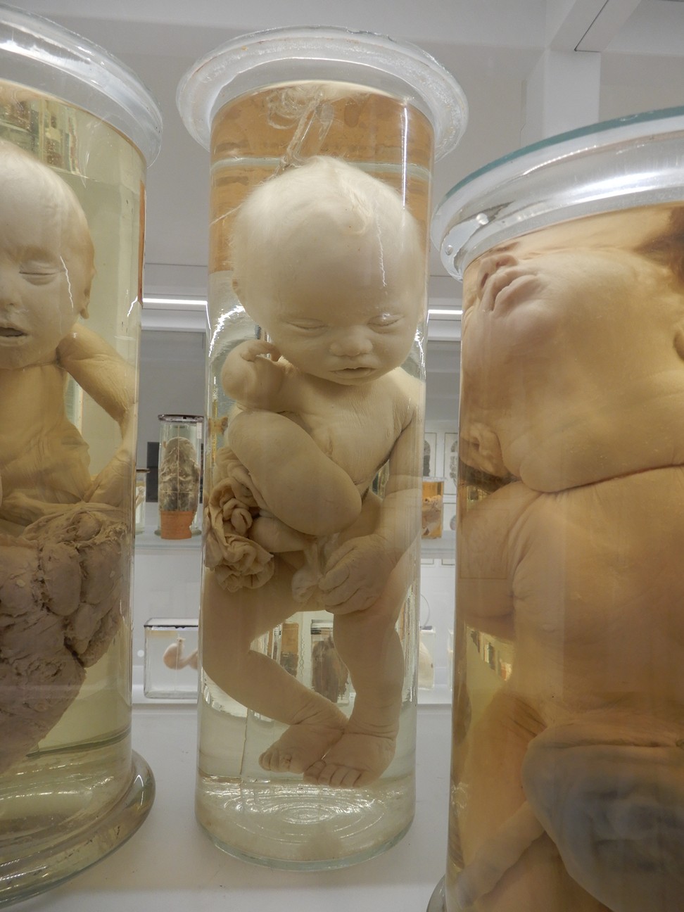 singolo reperto antropologico, preparato anatomico (morfologia alterata per patologia) (XIX-XX)