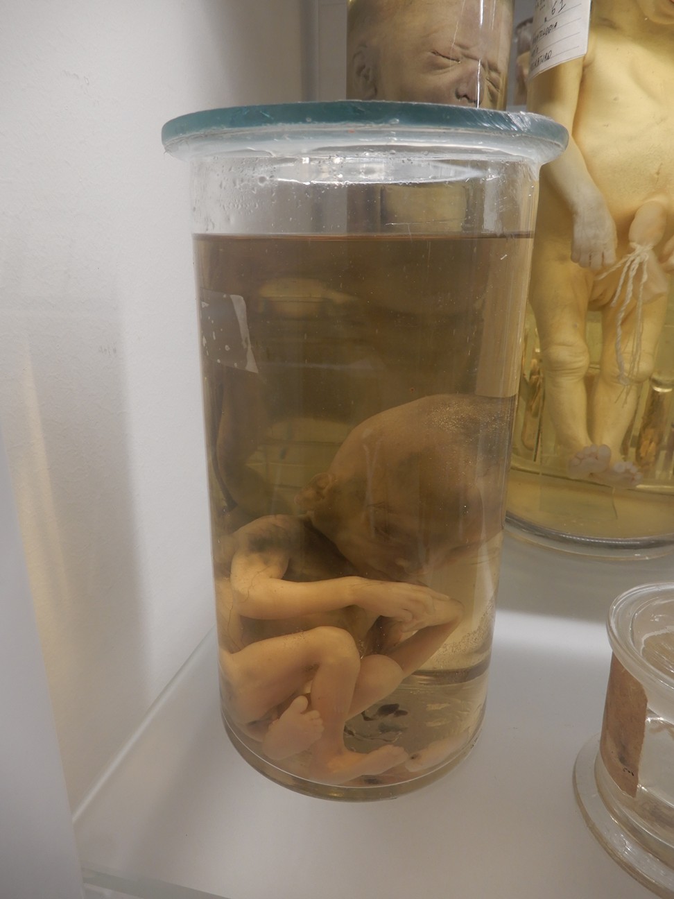 singolo reperto antropologico, preparato anatomico (morfologia alterata per patologia) (XIX-XX)