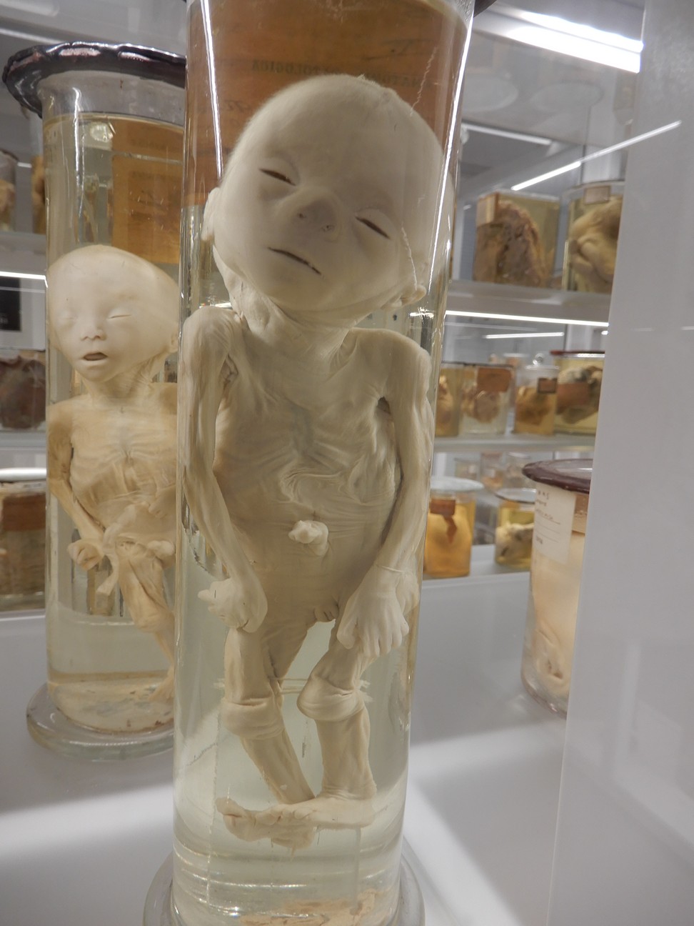 singolo reperto antropologico, preparato anatomico (morfologia alterata per patologia) (XIX-XX)