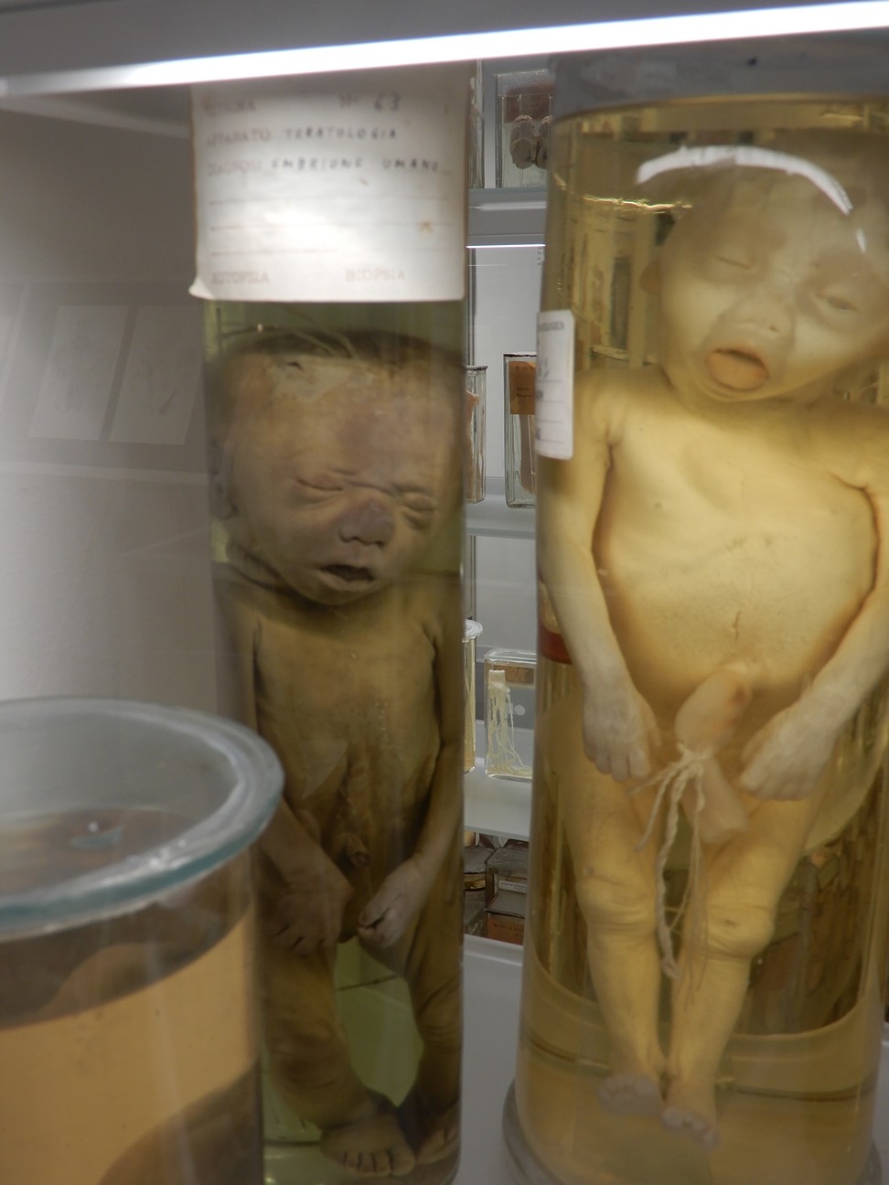 singolo reperto antropologico, preparato anatomico (morfologia alterata per patologia) (XIX-XX)