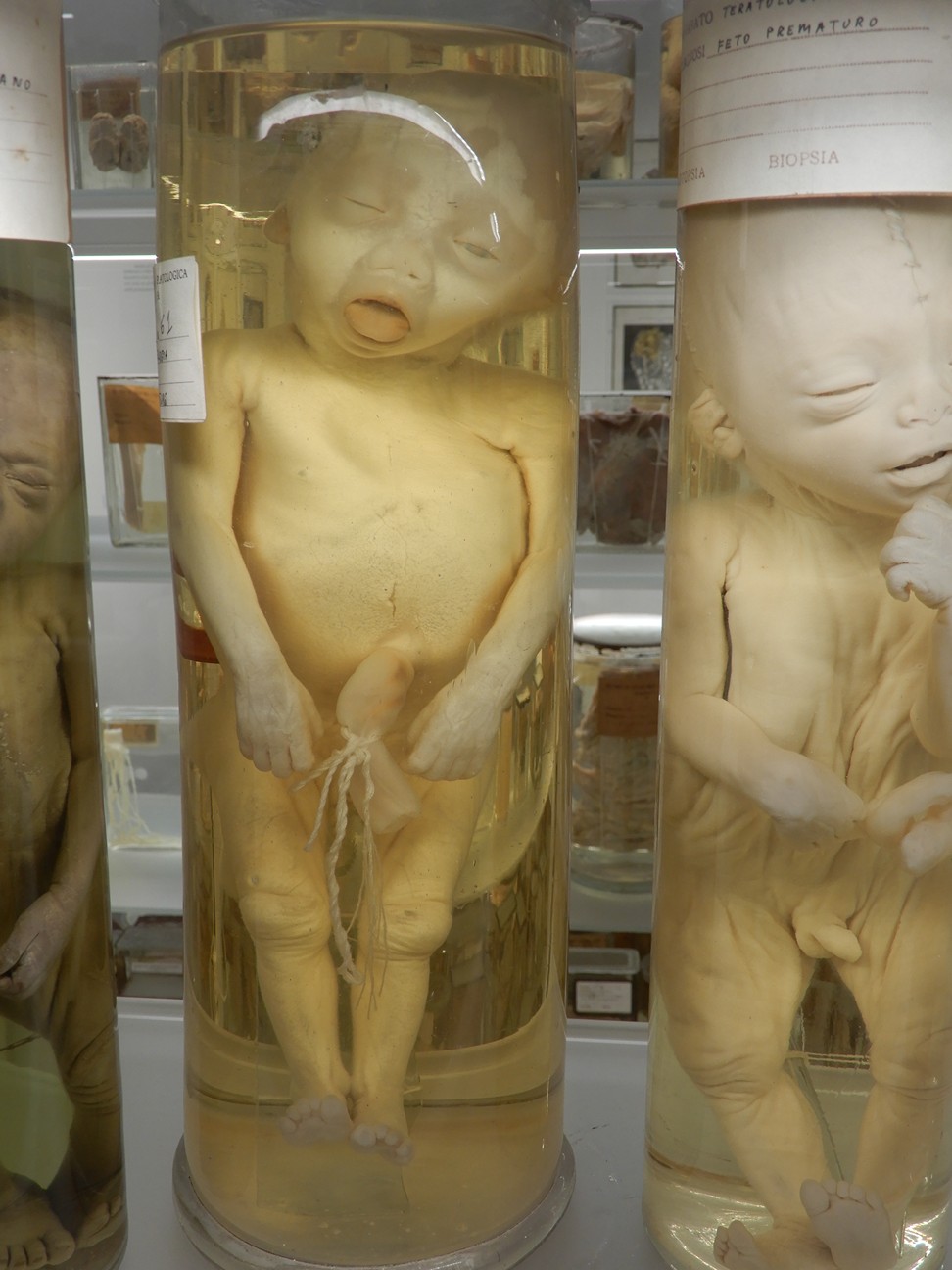 singolo reperto antropologico, preparato anatomico (morfologia alterata per patologia) (XIX-XX)