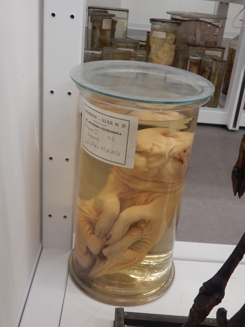 singolo reperto antropologico, preparato anatomico (morfologia alterata per patologia) (XIX-XX)