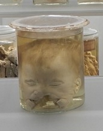 singolo reperto antropologico, preparato anatomico (morfologia alterata per patologia) (XIX-XX)