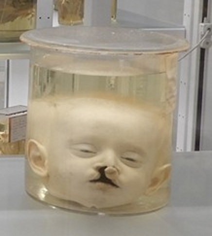 singolo reperto antropologico, preparato anatomico (morfologia alterata per patologia) (XIX-XX)