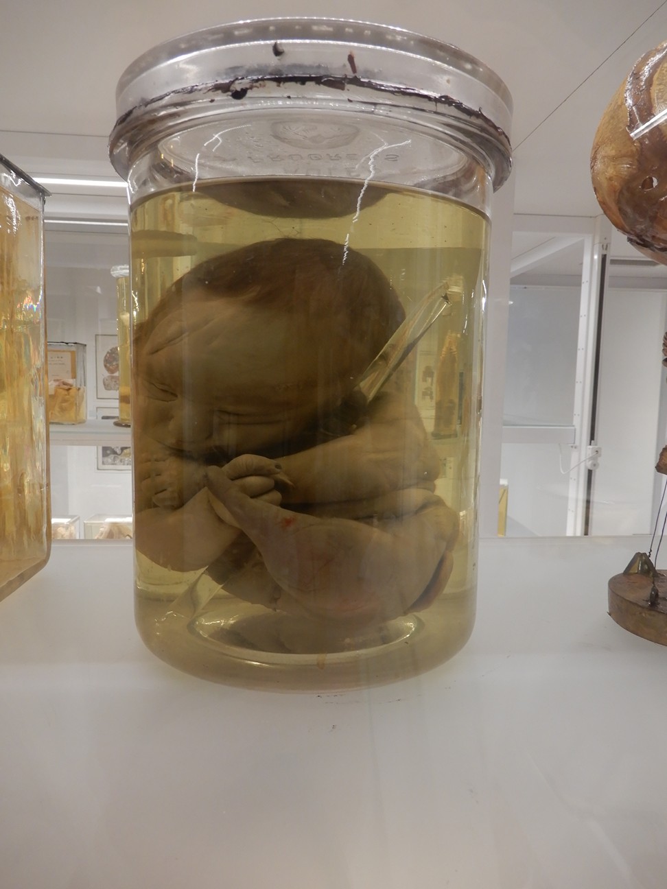 singolo reperto antropologico, preparato anatomico (morfologia alterata per patologia) (XIX-XX)