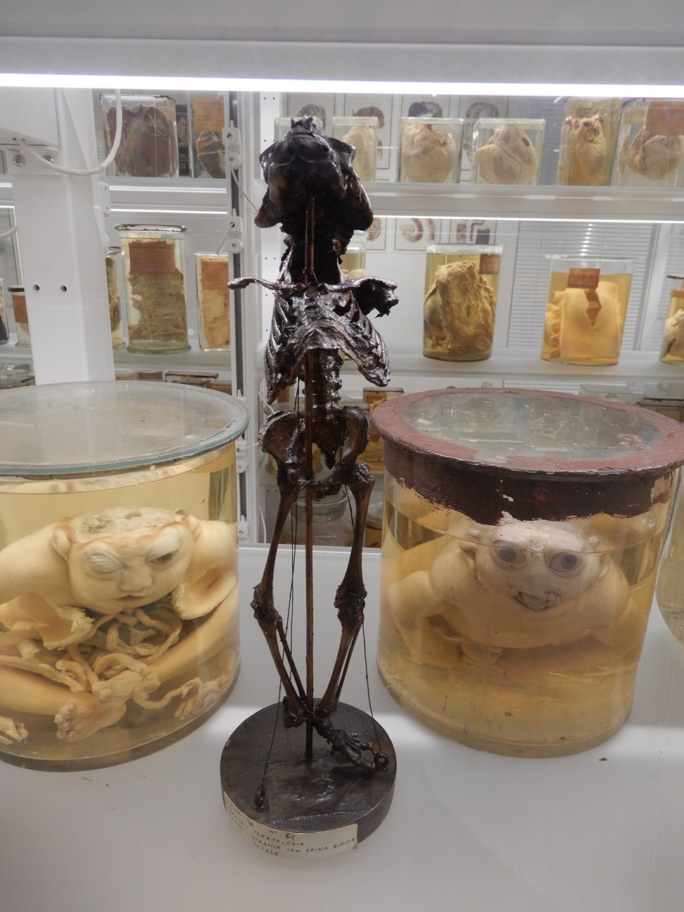 singolo reperto antropologico, preparato anatomico (morfologia alterata per patologia) (XIX-XX)