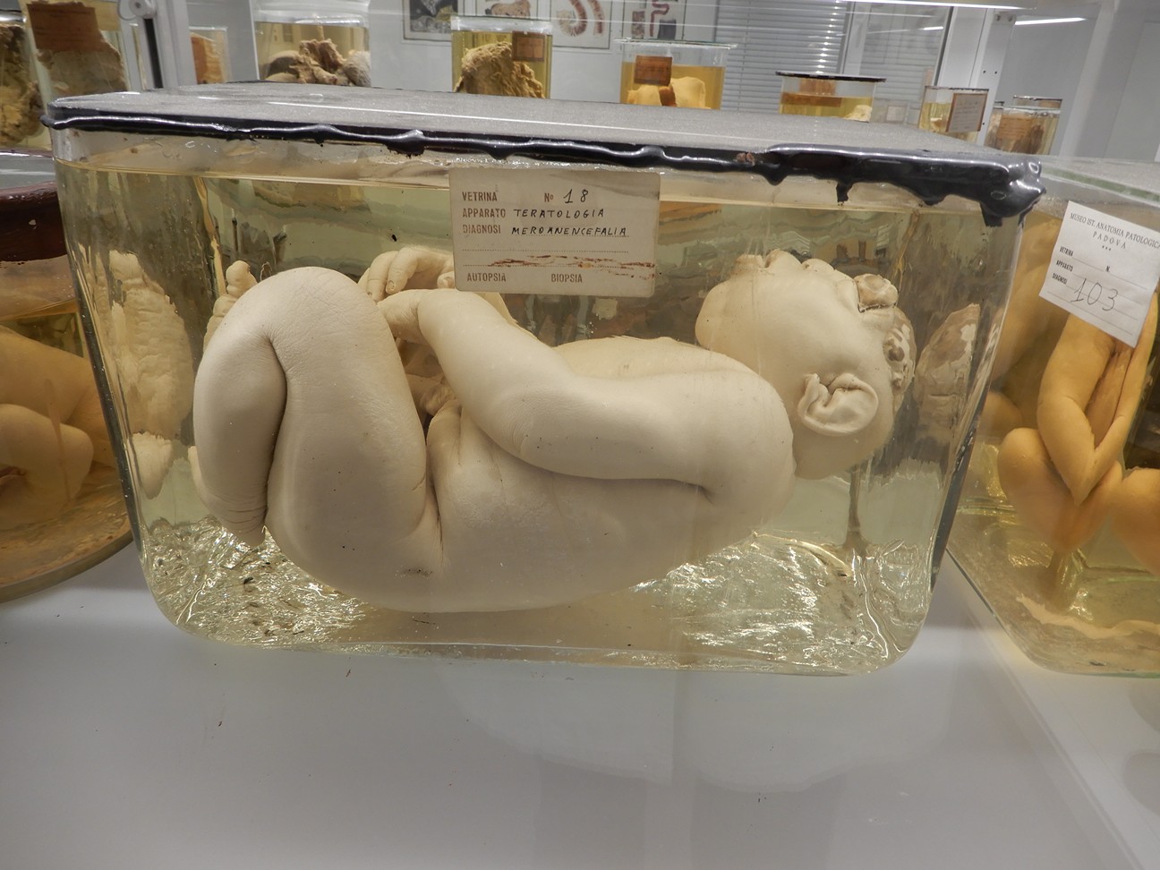 singolo reperto antropologico, preparato anatomico (morfologia alterata per patologia) (XIX-XX)