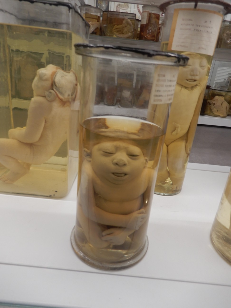 singolo reperto antropologico, preparato anatomico (morfologia alterata per patologia) (XIX-XX)