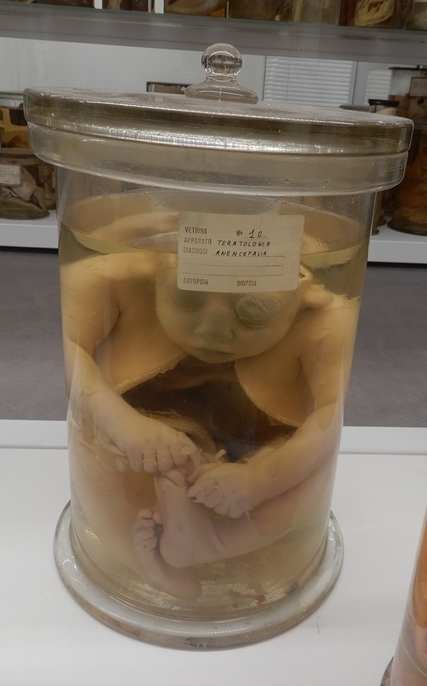 singolo reperto antropologico, preparato anatomico (morfologia alterata per patologia) (XIX-XX)