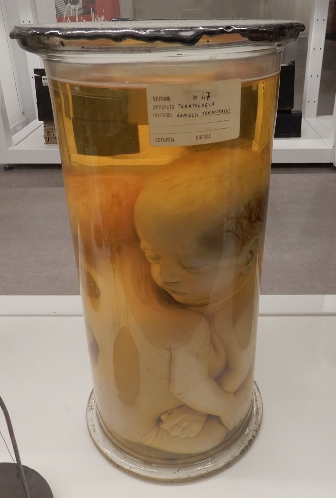 singolo reperto antropologico, preparato anatomico (morfologia alterata per patologia) (XIX-XX)