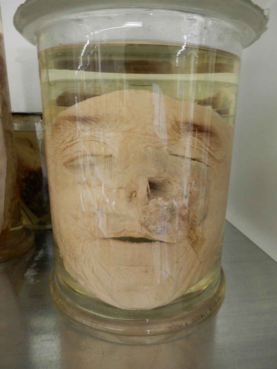 singolo reperto antropologico, preparato anatomico (morfologia alterata per patologia) (XIX-XX)