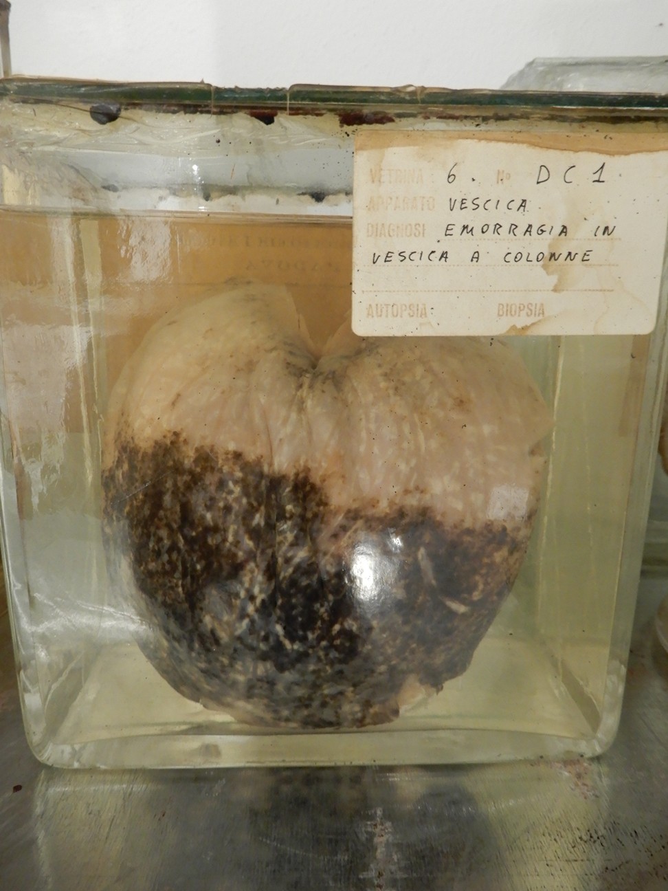 singolo reperto antropologico, preparato anatomico (morfologia alterata per patologia) (XIX-XX)