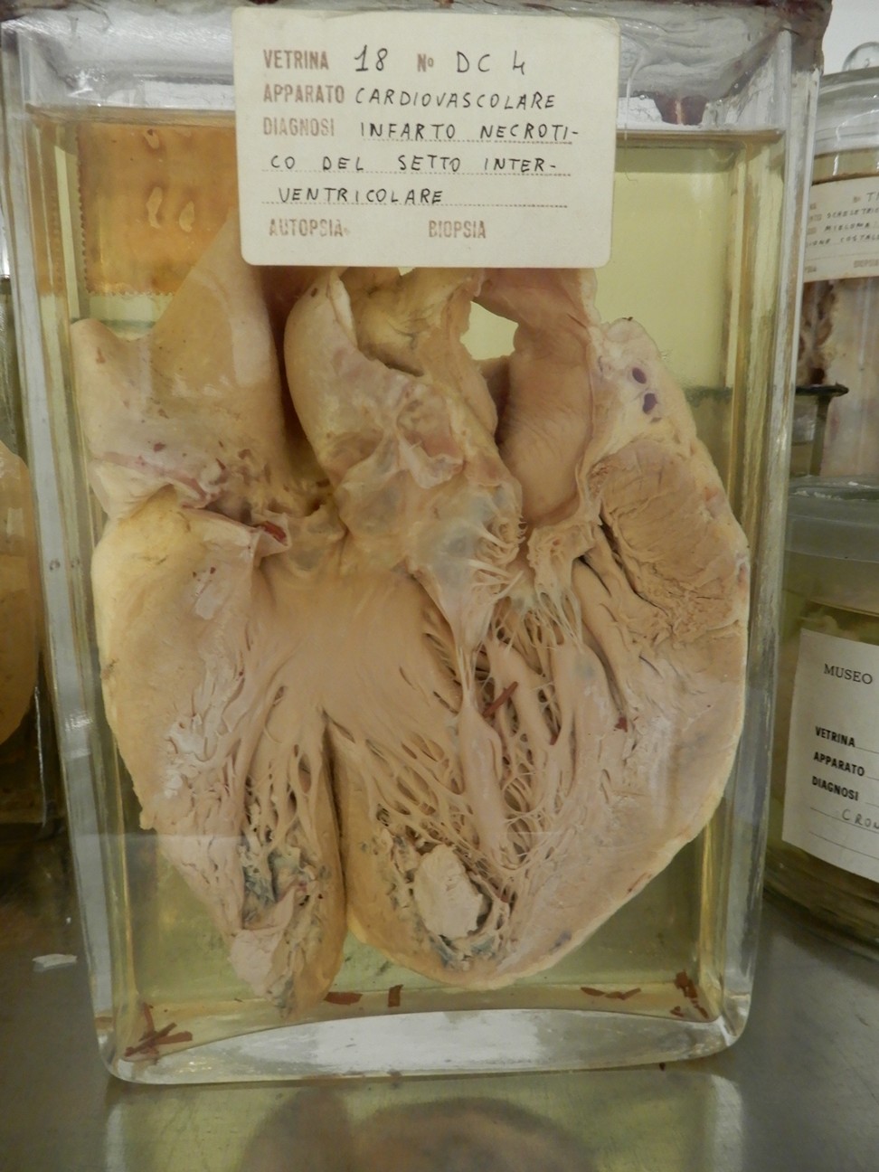 singolo reperto antropologico, preparato anatomico (morfologia alterata per patologia) (XIX-XX)