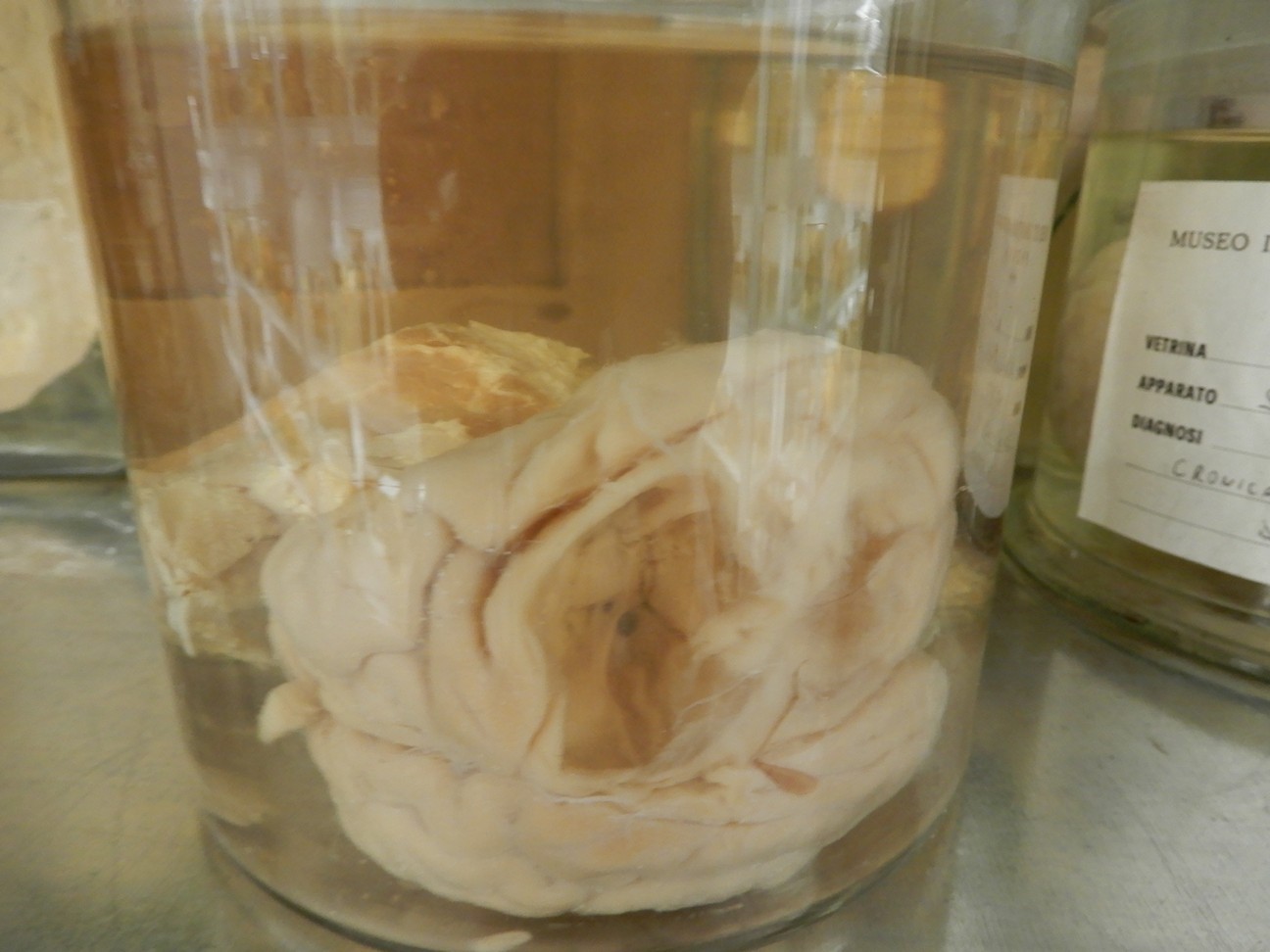 singolo reperto antropologico, preparato anatomico (morfologia alterata per patologia) (XIX-XX)