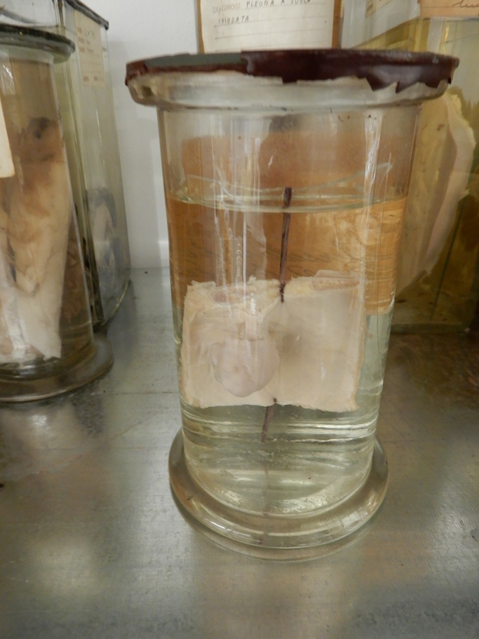 singolo reperto antropologico, preparato anatomico (morfologia alterata per patologia) (XIX-XX)