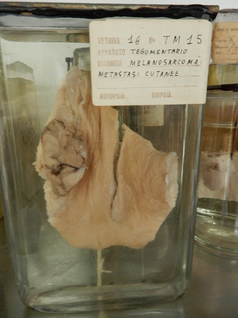 singolo reperto antropologico, preparato anatomico (morfologia alterata per patologia) (XIX-XX)